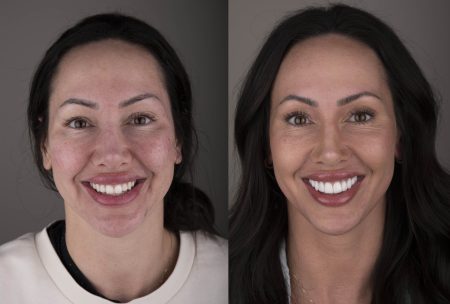 Before and after a dental facelift