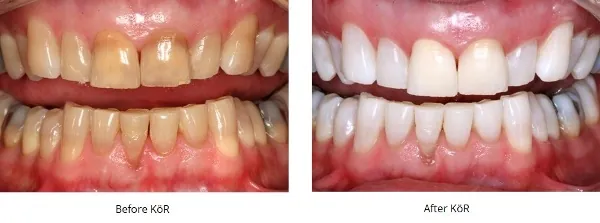 two photos of smiles - on the left dark, stained teeth - on the right, bright white teeth